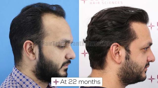 Right view of patient before and after