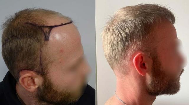 Right view of patient before and after