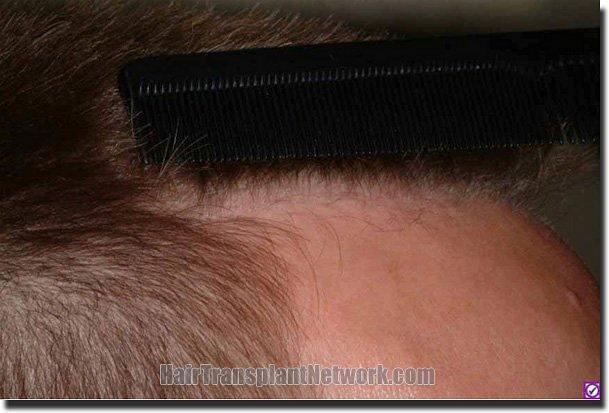 Hair restoration procedure results