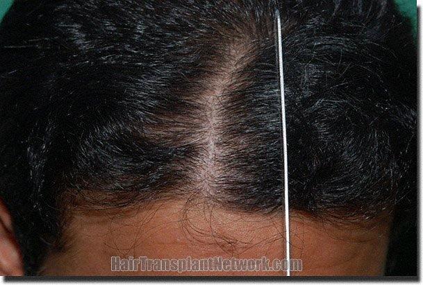 Hair restoration procedure results