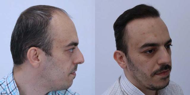 Right view of patient before and after