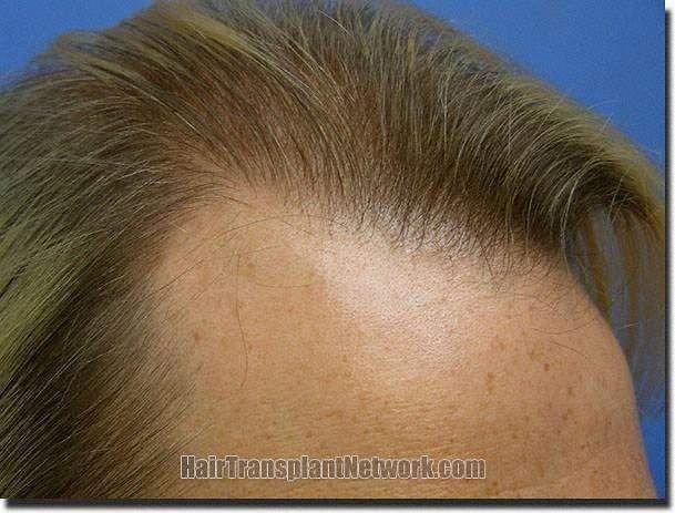 Hair restoration procedure results