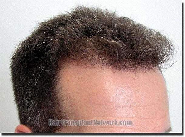 Hair restoration procedure results