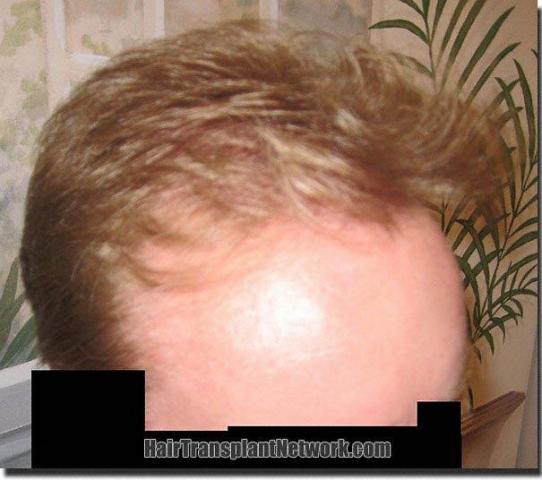 Hair restoration procedure results