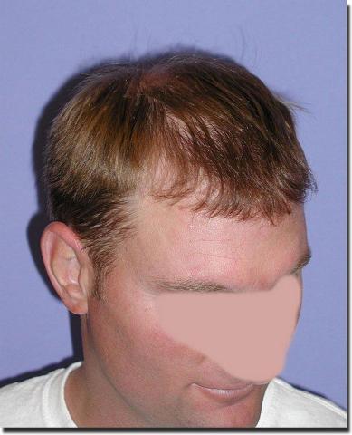 Hair restoration procedure results