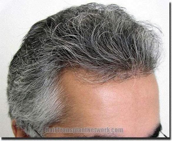 Hair restoration procedure results