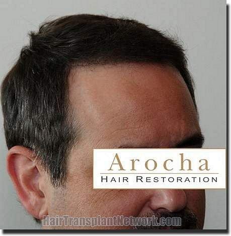 Hair restoration procedure results