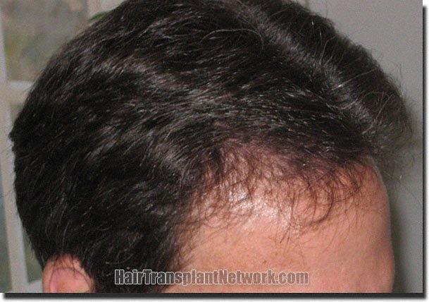 Hair restoration procedure results