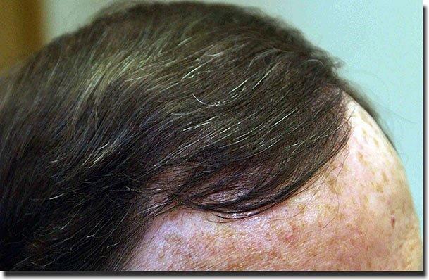 Hair restoration procedure results