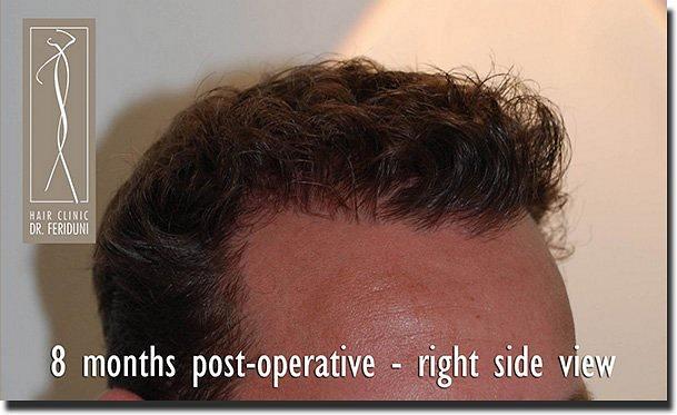 Hair restoration procedure results