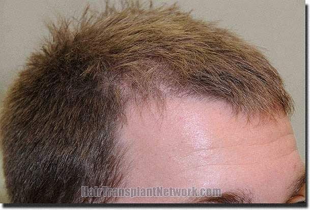 Hair restoration procedure results