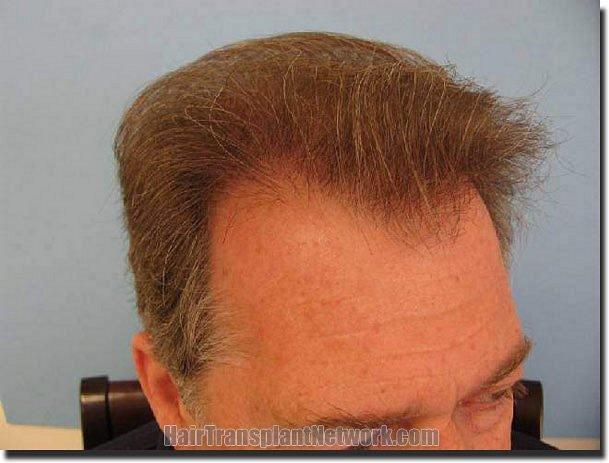 Hair restoration procedure results