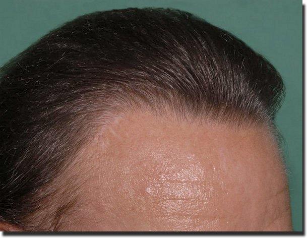 Hair restoration procedure results