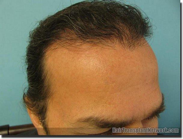 Hair restoration procedure results