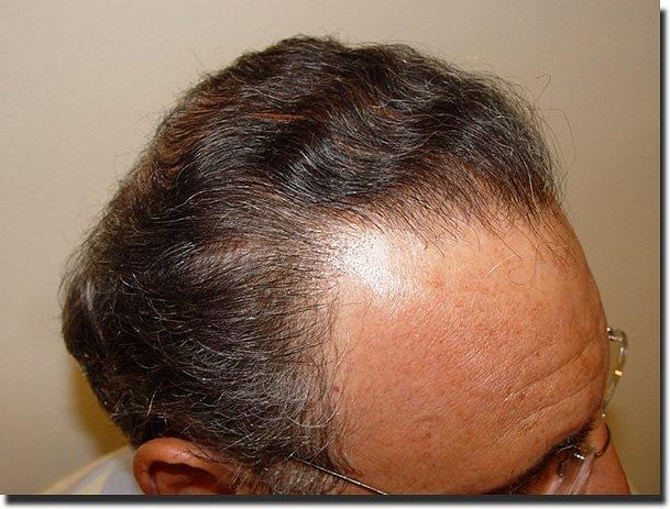 Hair restoration procedure results