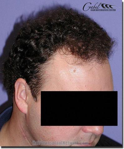 Hair restoration procedure results