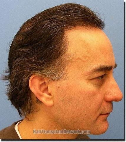 Hair restoration procedure results