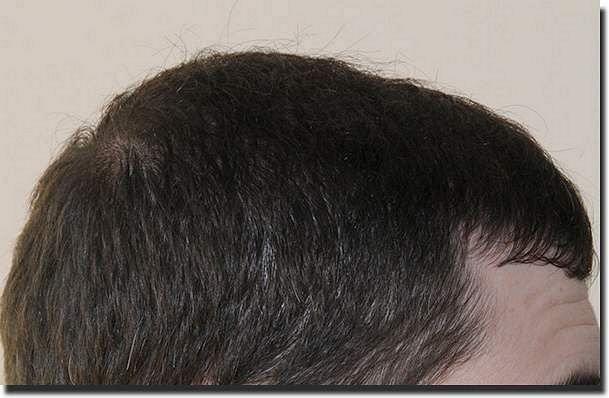 Hair restoration procedure results