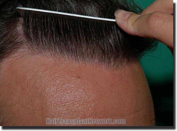 Hair restoration procedure results