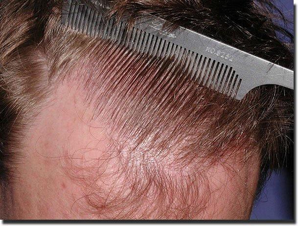 Hair restoration procedure results