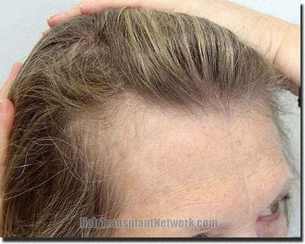 Hair restoration procedure results