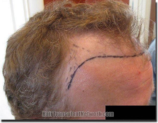 Hair restoration procedure results