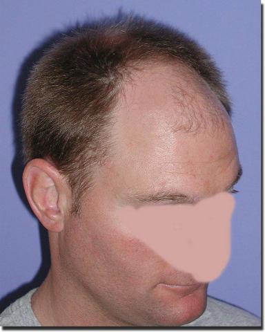 Hair restoration procedure results