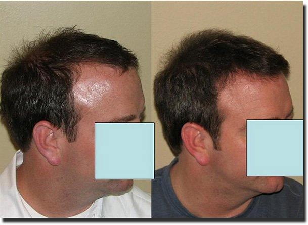 Hair restoration procedure results