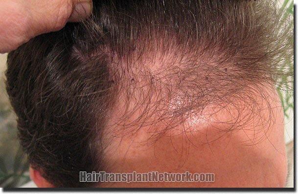 Hair restoration procedure results