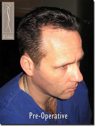 Hair restoration procedure results