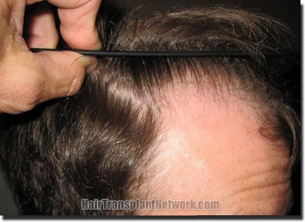 Hair restoration procedure results