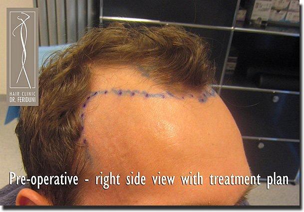 Hair restoration procedure results