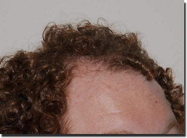 Hair restoration procedure results