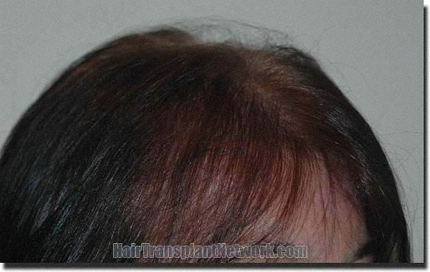 Hair restoration procedure results