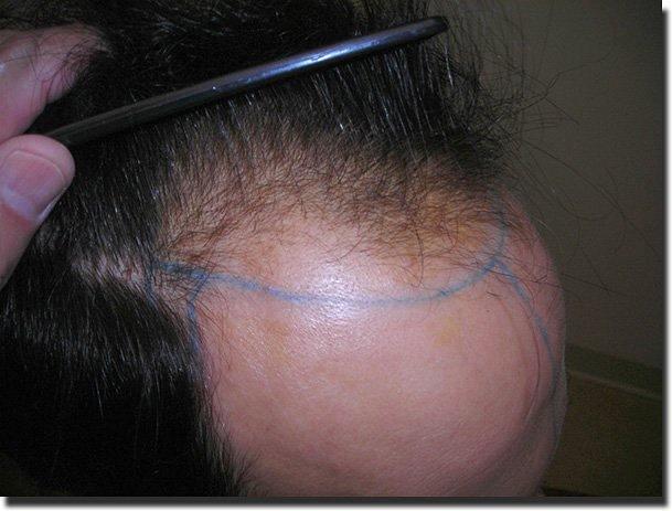 Hair restoration procedure results