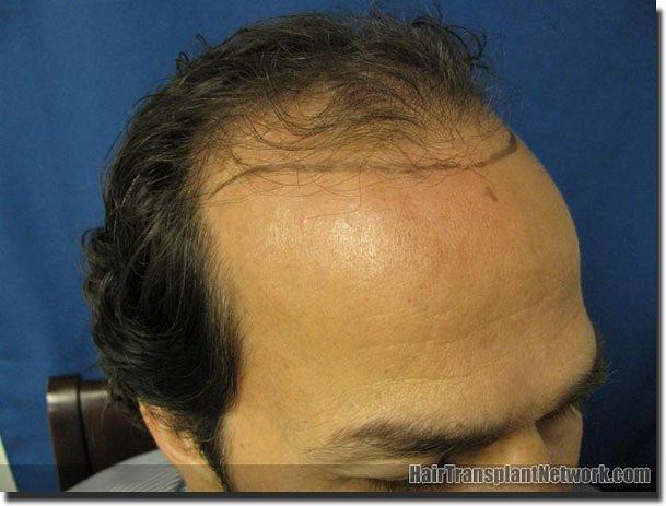 Hair restoration procedure results