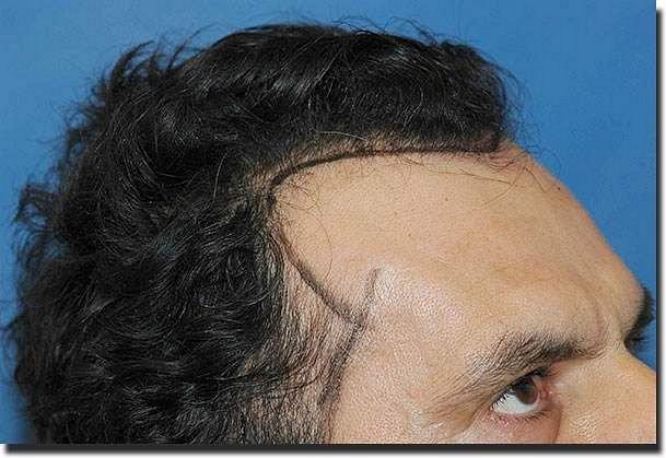 Hair restoration procedure results