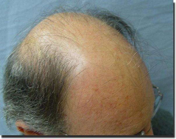 Hair restoration procedure results