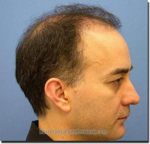 Hair restoration procedure results