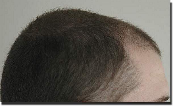 Hair restoration procedure results