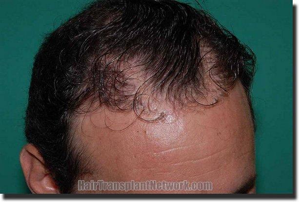 Hair restoration procedure results