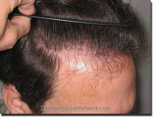 Hair restoration procedure results