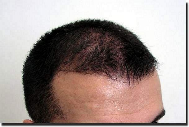 Hair restoration procedure results