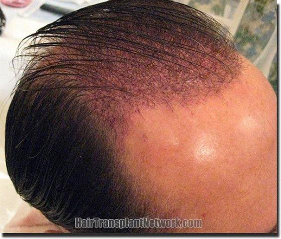 Hair restoration procedure results