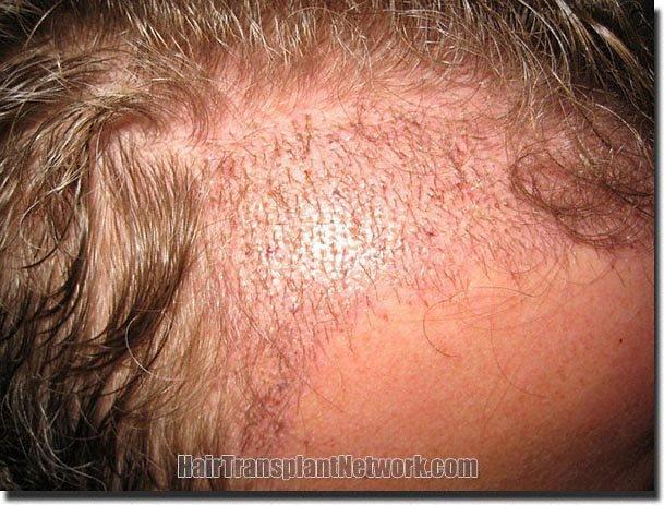 Hair restoration procedure results