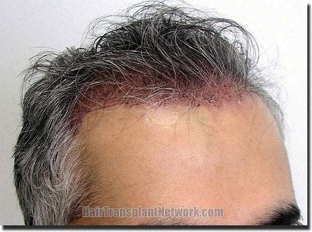 Hair restoration procedure results