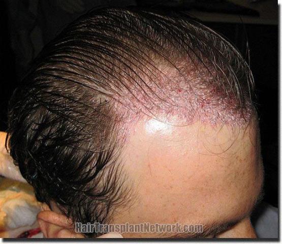 Hair restoration procedure results