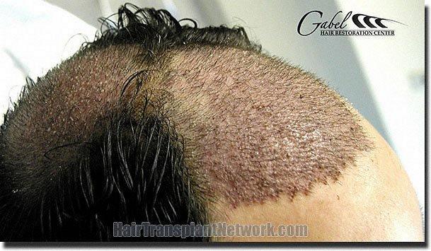 Hair restoration procedure results