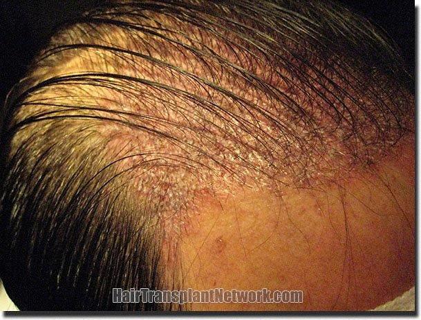 Hair restoration procedure results