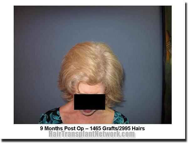 Hair restoration procedure results